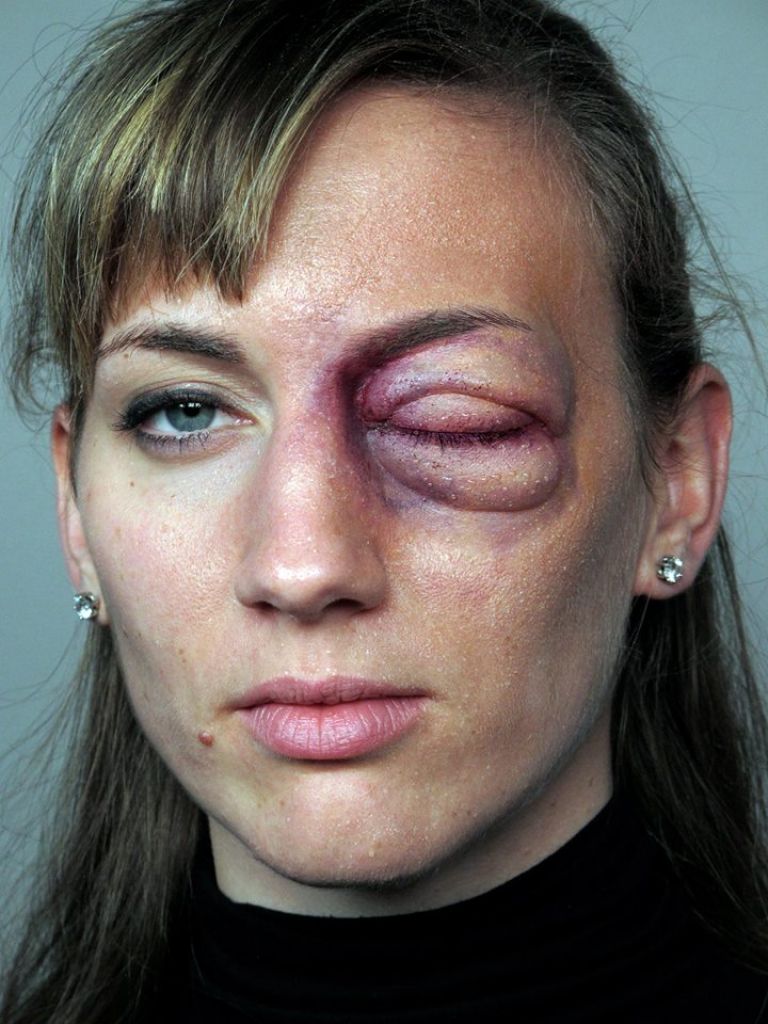 Swollen Eye Prosthetic