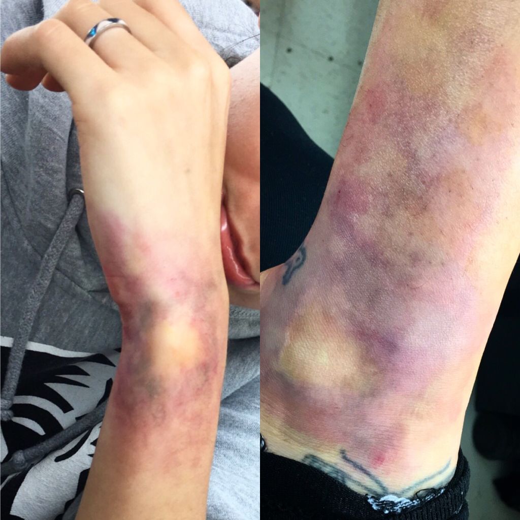 Bruises