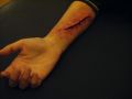 Burns and Wounds