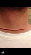 Lacerated neck